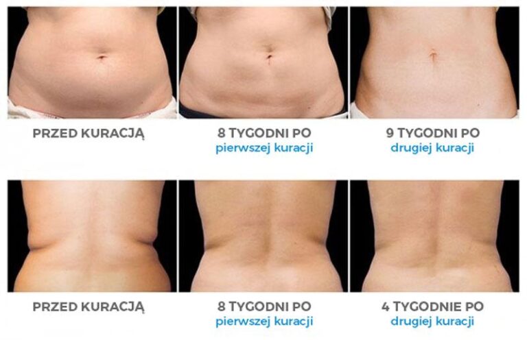 Jak długo cieszyć się efektami kriolipolizy? Odkryj prawdę!