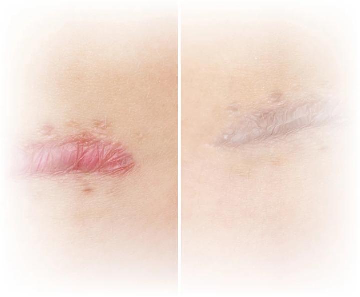 Metoda scarink regeneracja skóry