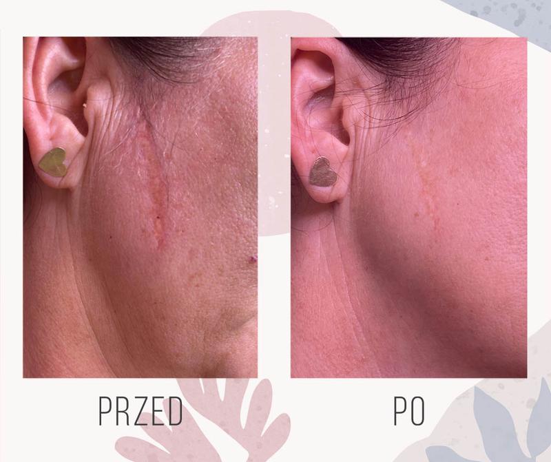 Mikropunktura blizn i rozstępów