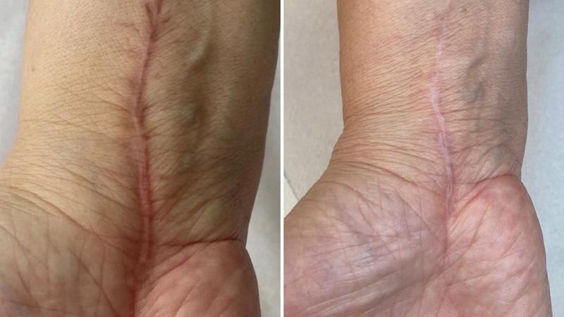 Terapia blizn porównanie metod