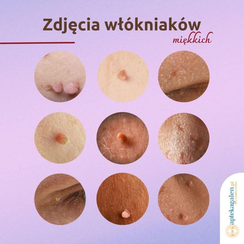 Jak skutecznie usunąć włókniaki samemu? Czego potrzebujesz z apteki?