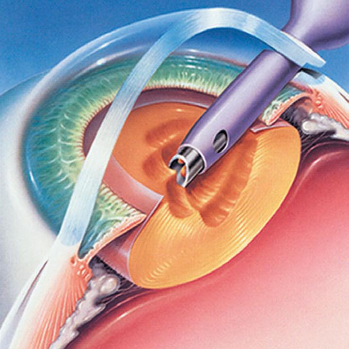 Jak przygotować się do operacji zaćmy w kontekście cukrzycy i nadciśnienia: ważne informacje dla pacjentów z chorobami współistniejącymi