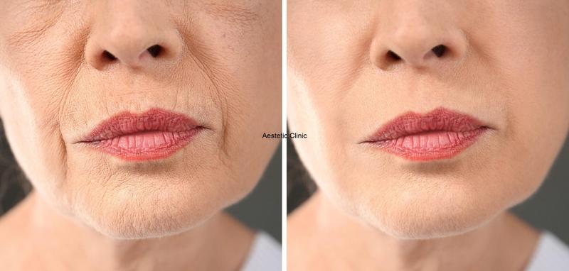 Jak skutecznie walczyć z zmarszczkami palacza?