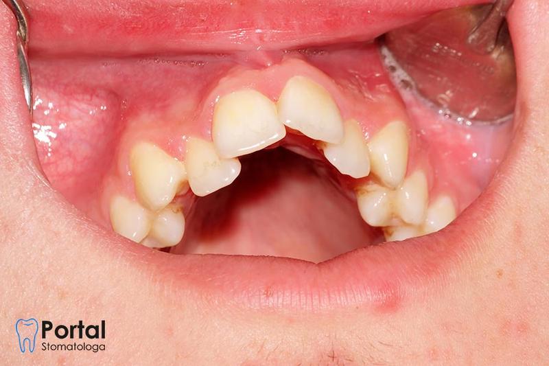 Przyczyny i objawy podniebienia gotyckiego