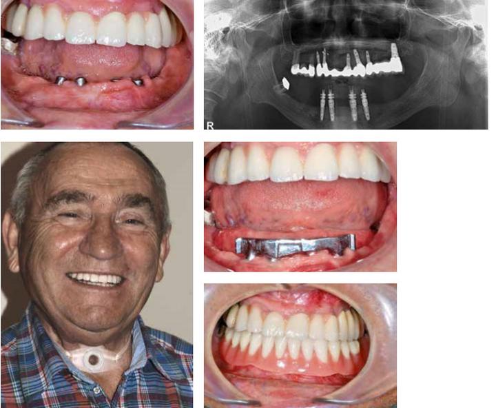 Wpływ na wymowę i karmienie